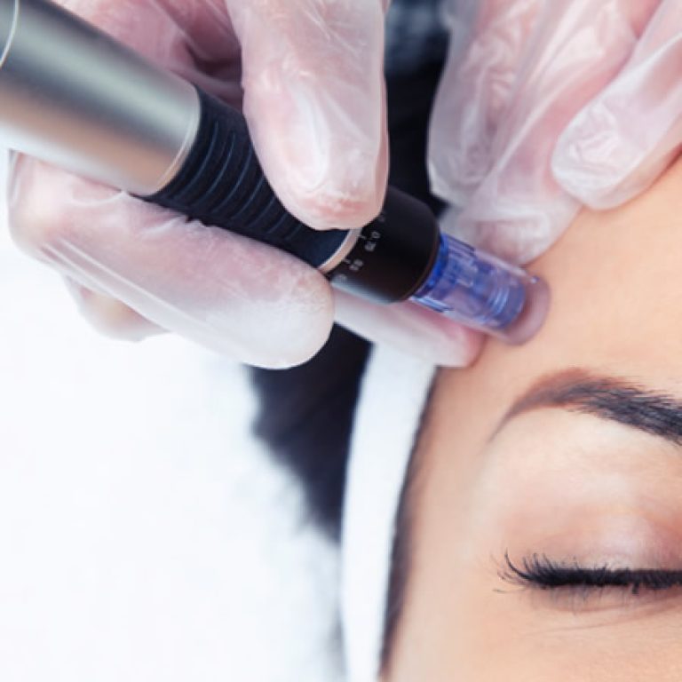Microneedling Deluxe Facial